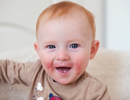 Study finds asthma and food allergies predictable at age one